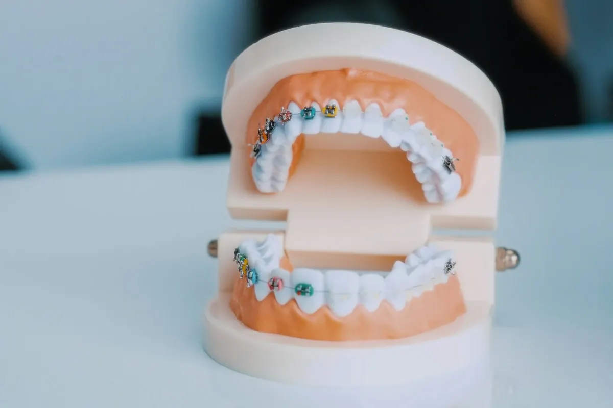 Orthodontic brackets set on a study model