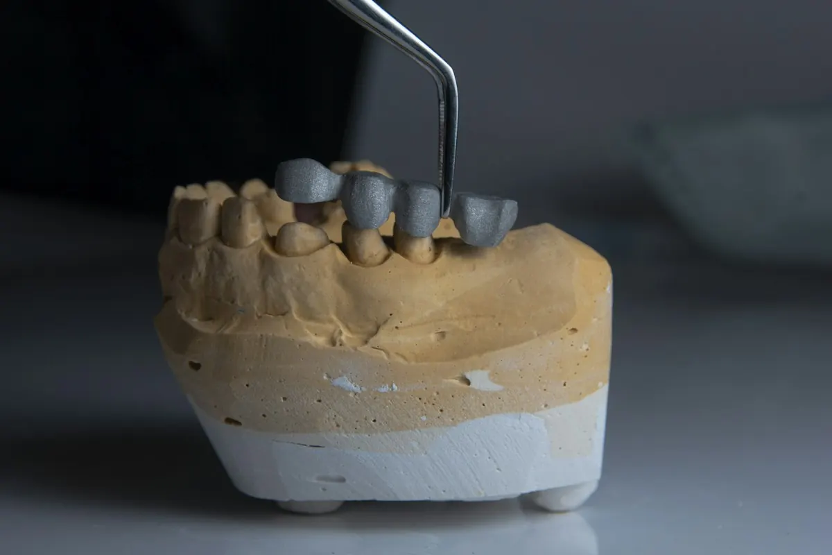 A bridge resting on a stone dental model