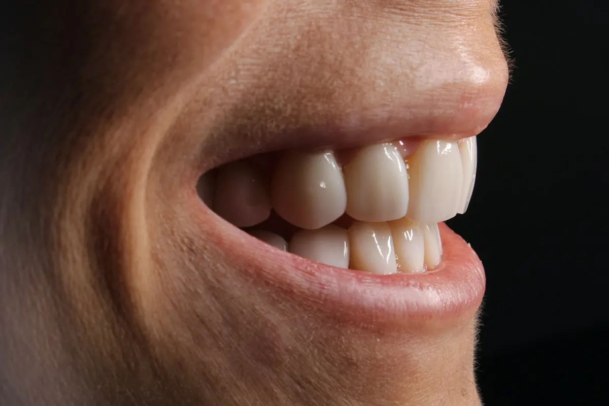 A smile showing the gumline above the upper teeth