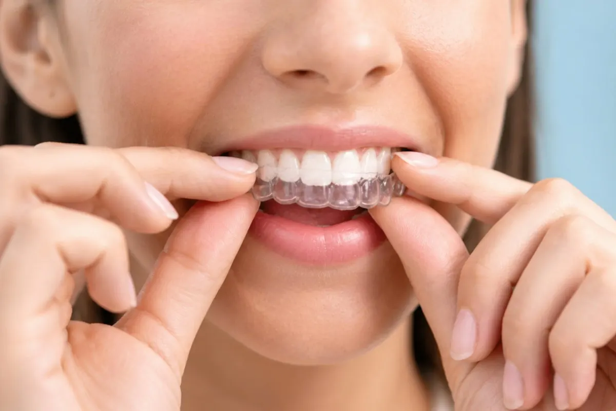 A clear aligner being seated over the upper teeth