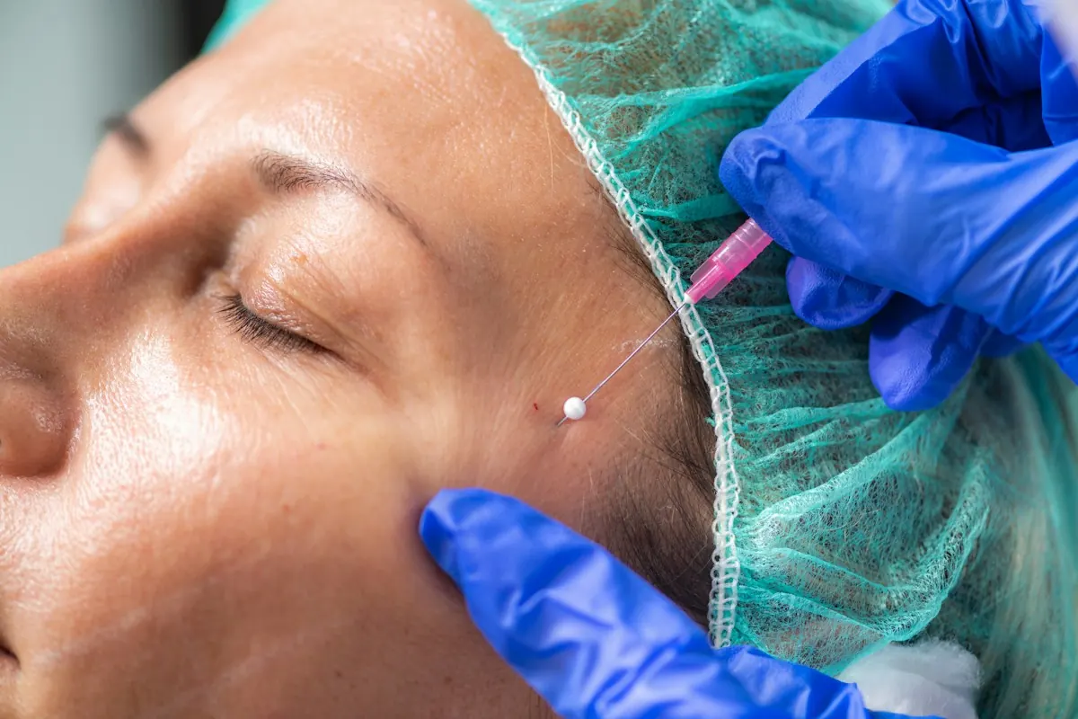 Threads placed to lift and contour the cheek
