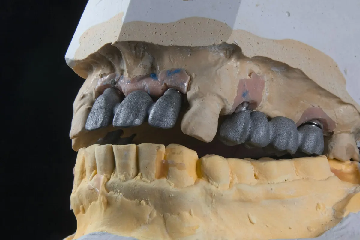 An implant model showing the surrounding tissue