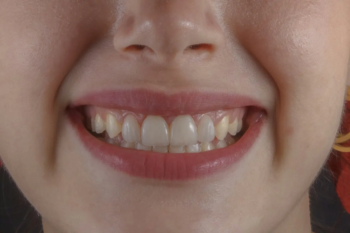 A close view of restored upper front teeth