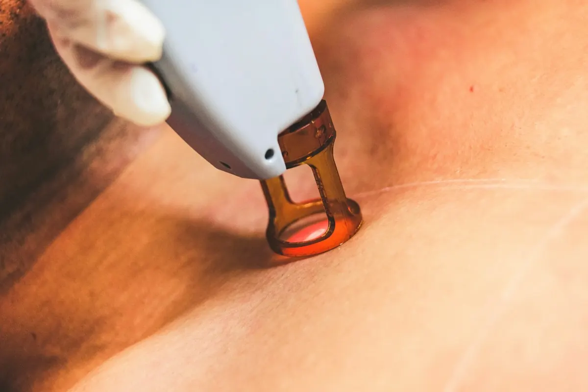 A radiofrequency applicator worked across the skin