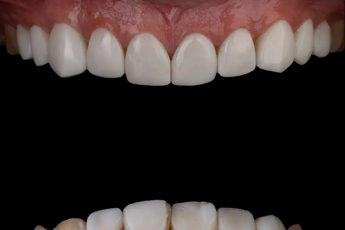 Bright upper teeth against a dark background